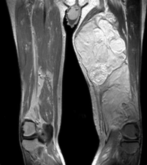 Liposarcoma Of The Thigh Radiology Case Radiology