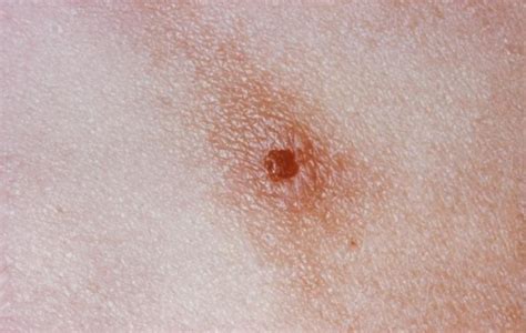 Gonorrhea Symptoms Skin Gertymonitor