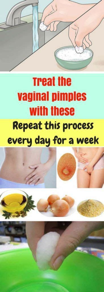 Treat The Vaginal Pimples These Repeat This Process Every Day For A