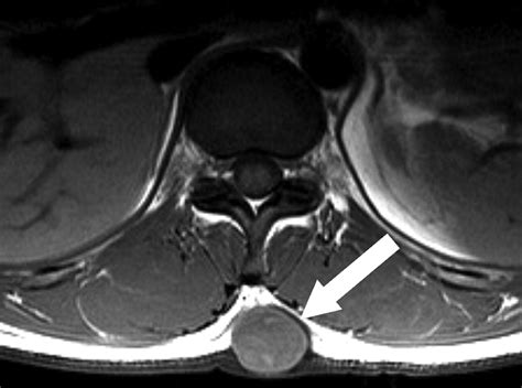 Mri Findings Of Subcutaneous Epidermal Cysts Emphasis On The Presence