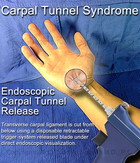 Endoscopic Carpal Tunnel Release Carpal Tunnel Syndrome Lake Oswego Or