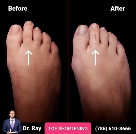 Toe Shortening Surgery Everything You Need To Know