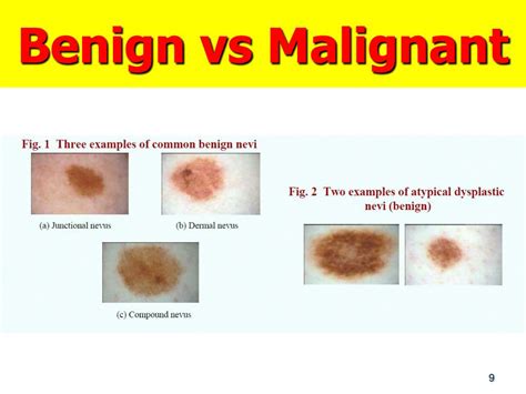 Ppt Melanoma And Skin Cancers Vs Image Processing Powerpoint