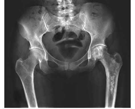 Case 3 Pre Operative Anteroposterior Radiograph Of The Pelvis Of A