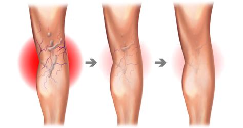 What Causes Varicose Veins Causes Prevention And Treatment