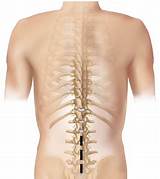 Images of Posterior Lumbar Fusion Recovery Time