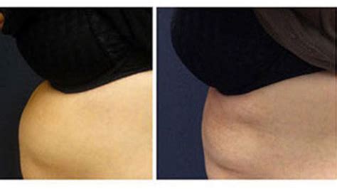 Sculpsure View Images Before And After Treatment