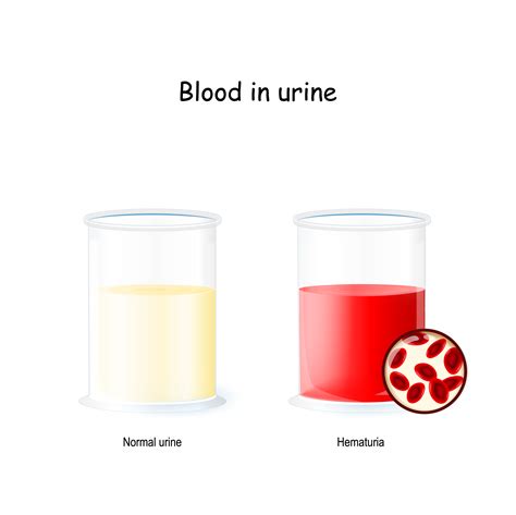 Hematuria Blood In Urine Feifer Urology