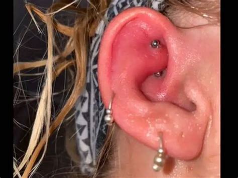 Infected Ear Piercing—symptoms Causes Prevention With 5 Important Treatment Steps Sleck