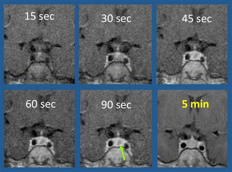 Dynamic Ce Imaging Questions And Answers In Mri