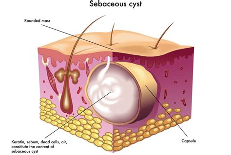 Sebaceous Cyst Durai The Surgeon