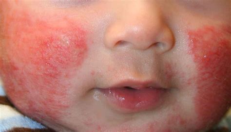 Common Skin Rashes In Babies Courtney Baldwin