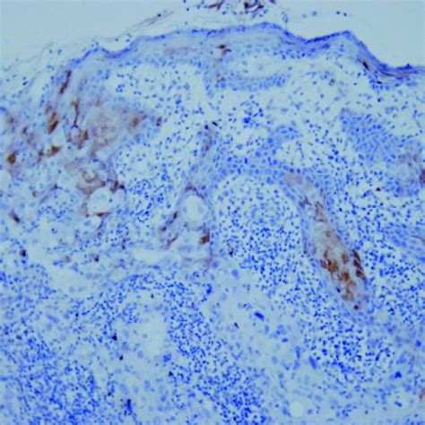 P16 Immunohistochemical Staining Of The Lesion At 200x Magnification