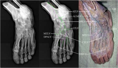 The Deep Lymphatic Anatomy Of The Foot