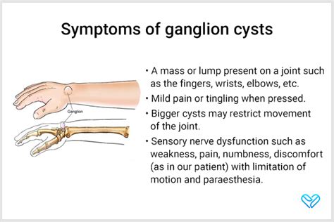 Ganglion Cysts Causes Symptoms Diagnosis Treatment