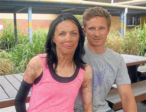 Incredible Story Of Bushfire Survivor Turia Pitt Michael Hoskin Will