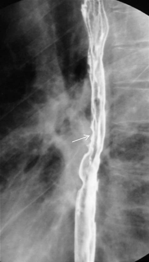Barrett S Esophagus Upright Lpo Image Of Double Contrast Barium