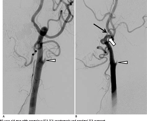 Pdf Anomalous External Carotid Artery Internal Carotid Artery Anastomosis In Two Patients With