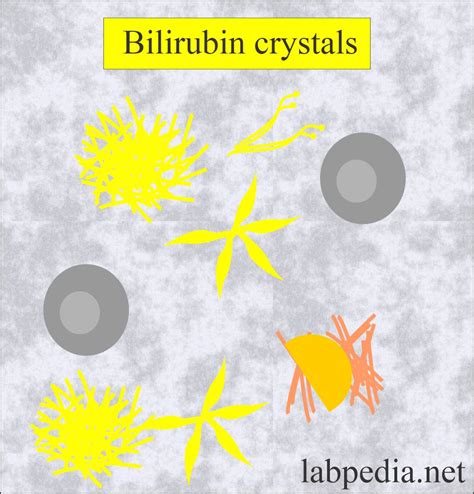 Urine Crystals Crystalluria