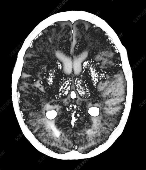 Stroke Brain Damage Ct Scan Stock Image C0388674 Science Photo