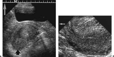 Retroverted Uterus Ultrasound