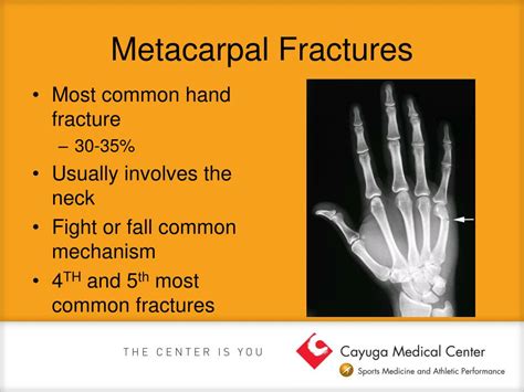 Ppt Common Hand And Wrist Injuries Powerpoint Presentation Free