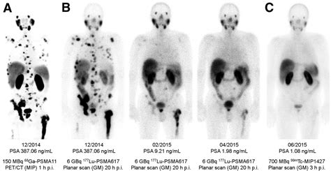 Psma Targeted Radionuclide Therapy Of Metastatic Castration Resistant