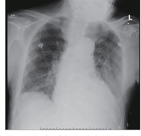 Figure 2 From A Case Of Early Prosthetic Valve Endocarditis Caused By