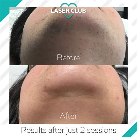 Pcos Hair Growth How Can Laser Hair Removal Help Laser Club