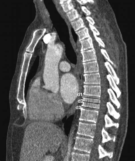 Alterations Of The Thoracic Spine In Marfans Syndrome Ajr