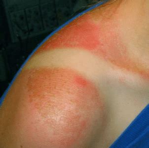 How to treat a sunburn. How long do Sunburn Blisters Last, on Lips, Face ...