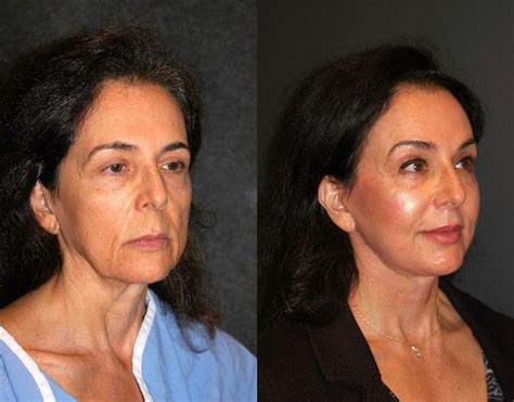 Deep Plane Facelift Before And After Dr Andrew Jacono Celebrity Plastic Surgery Best