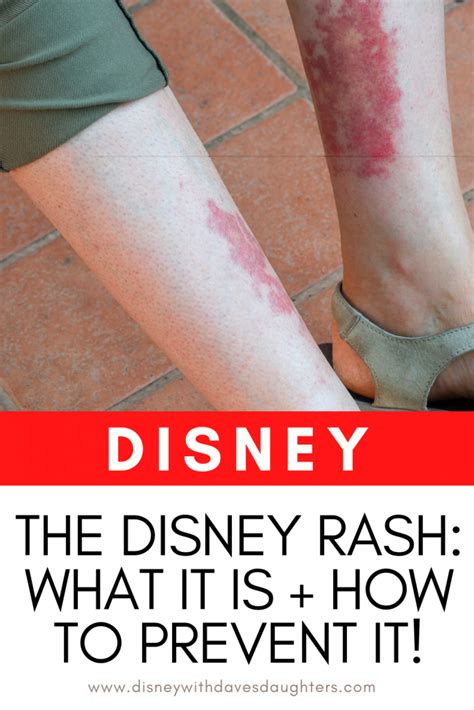 Disney Rash How To Treat And Prevent Disney With Daves Daughters