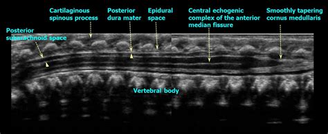 Baby Spine Medical Ultrasound Sonography Ultrasound