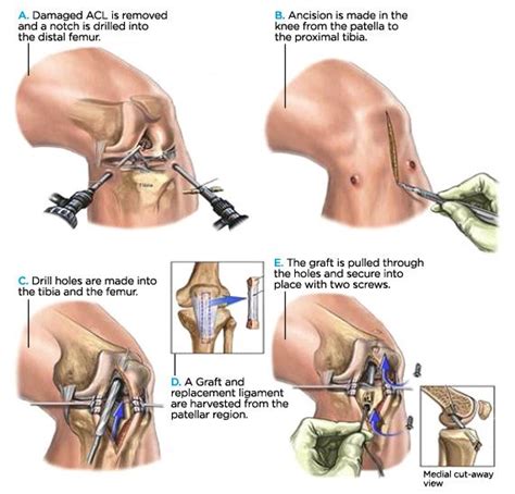 Anatomy Of An Injury Acl Anterior Cruciate Ligament Tear Acl
