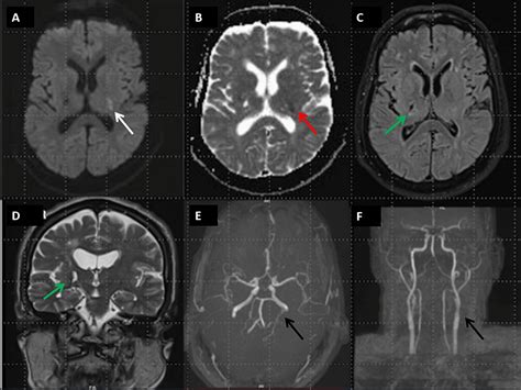 Cureus Ipsilateral Hemiparesis In A Patient With Existing
