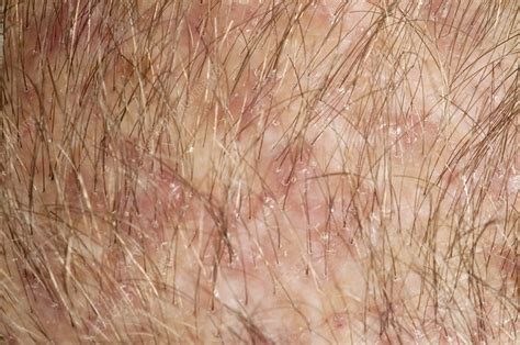 Folliculitis Of The Scalp Stock Image C0258047 Science Photo Library