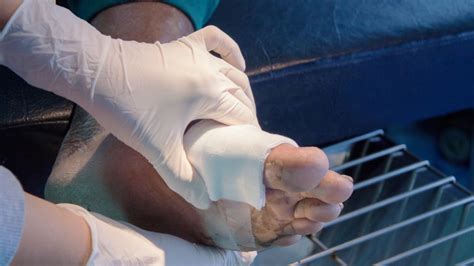Caring For A Diabetic Foot Wound Theskfeed