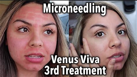 My 3rd Venus Viva Treatment For Acne Scars And Pores Results Youtube