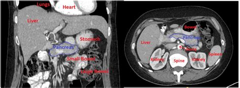 How To Segment A Pancreas Ct A Guide For Finding And Tracing By