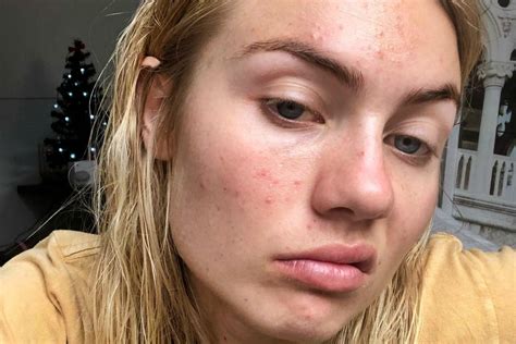 Elyse Knowles Posts Makeup Free Selfie To Talk About Pimple Battles