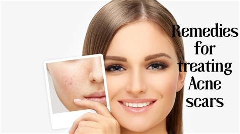 remedies for treating acne scars skin beauty