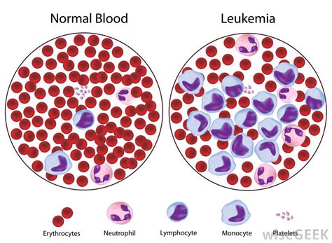 June 21 to july 22. What is Blood Cancer? - Medikoe