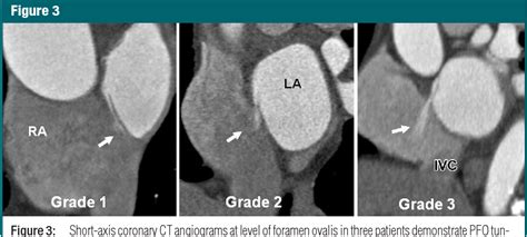 Figure 3 From Imaging Of Patent Foramen Ovale With 64