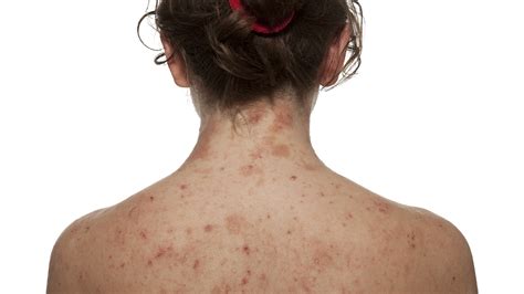 Dermatitis Atópica De Qué Se Trata La Enfermedad Crónica De La Piel