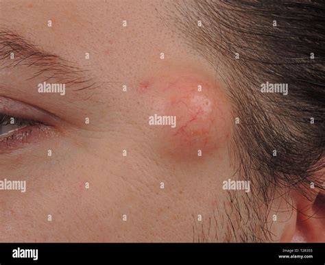 Sebaceous Cyst High Resolution Stock Photography And Images Alamy