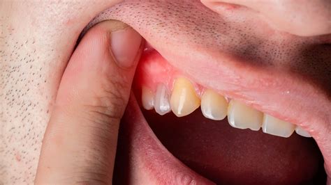 11 Home Remedies For Swollen Gums
