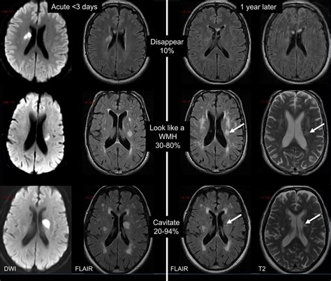 Update On Cerebral Small Vessel Disease A Dynamic Whole Brain Disease