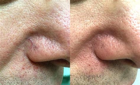 Intense Pulsed Light Ipl Before And After Photo Gallery Natick Ma