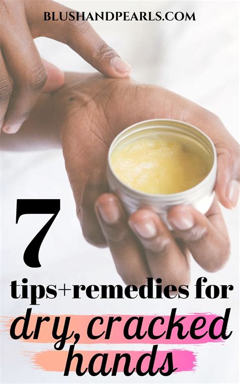 Suffering From Dry Hands Here Are 7 Remedies To Help